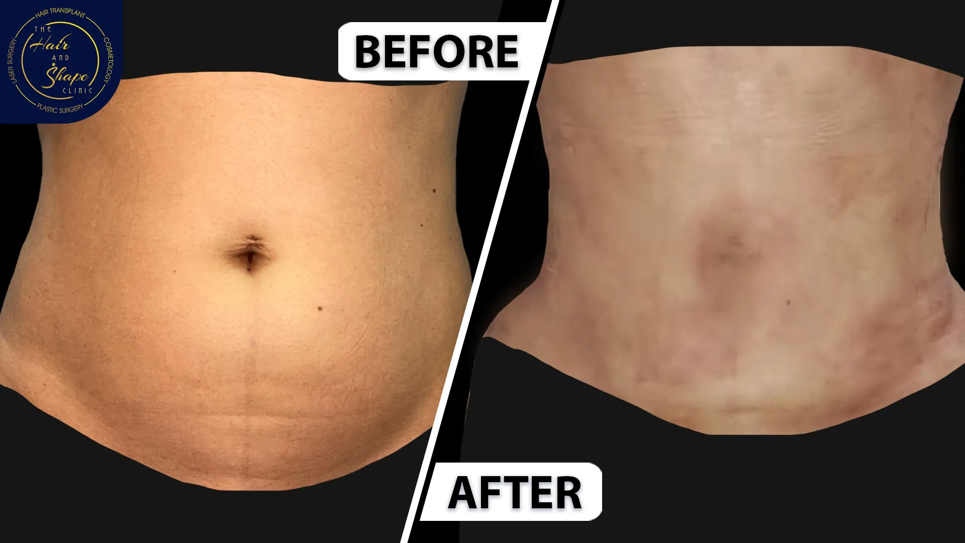 Tummy Liposuction result